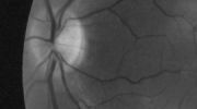 Optic disc and retinal boundary